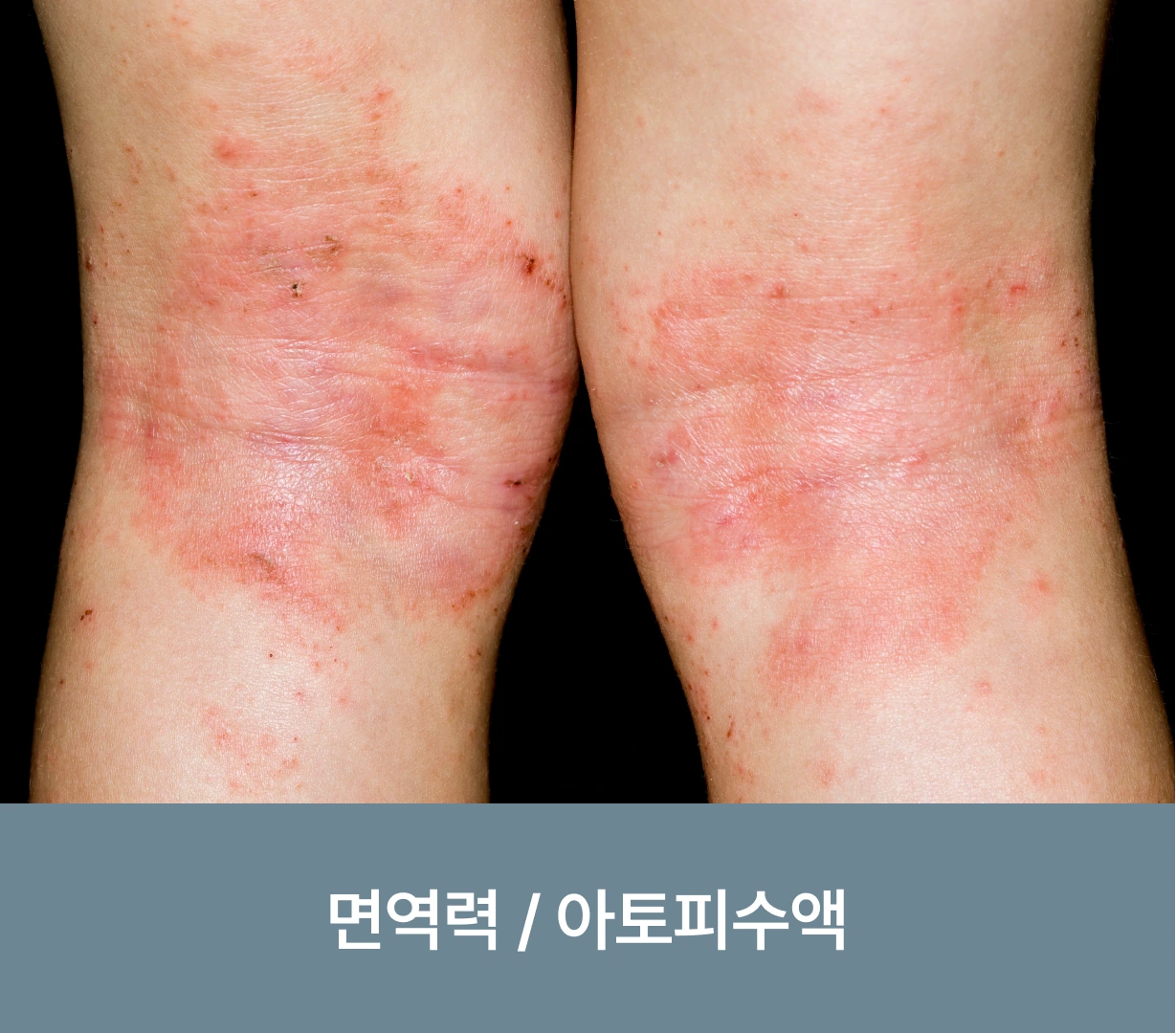 면역력/아토피수액